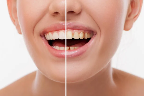 Mujer después y antes del blanqueamiento de dientes —  Fotos de Stock