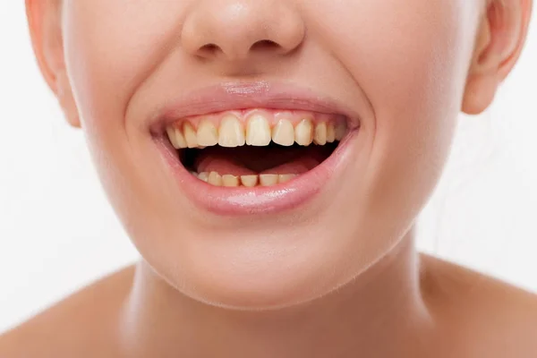 Mujer sonriente con dientes amarillos — Foto de Stock