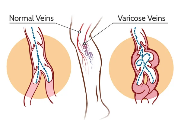Illustrazione delle vene varicose — Vettoriale Stock