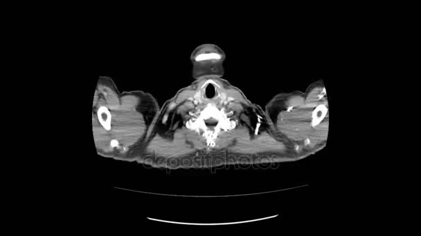 Ct exploración de la parte superior del abdomen vista superior movimiento suave — Vídeos de Stock