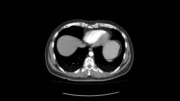 腹部上面滑らかな動きの ct スキャン — ストック動画