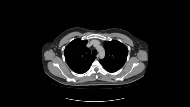 Ct exploración de la parte superior del abdomen vista superior movimiento suave — Vídeos de Stock