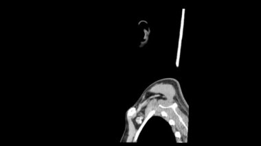 CT taraması boyun yan görünüm