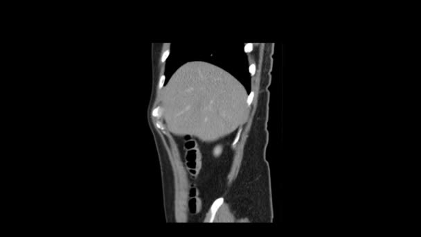 ct scan de l'abdomen vue latérale mouvement lisse 
