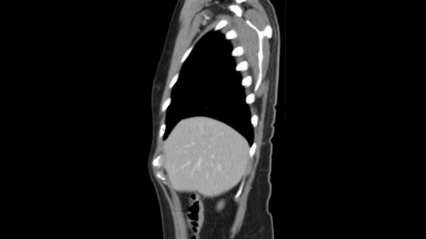 ct scan de l'abdomen vue latérale mouvement lisse 