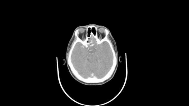 Αξονική Τομογραφία Του Ανώτερου Λαιμών Κάτοψη Ομαλή Κίνηση — Αρχείο Βίντεο