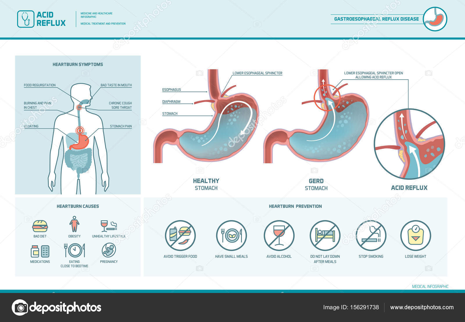 Acid reflux and heartburn infographic — Stock Vector © elenabs 156291738
