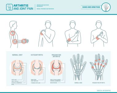 Artrit ve eklem ağrısı Infographic