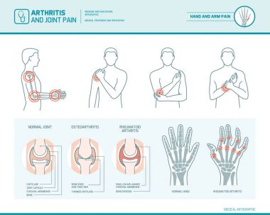 Arthritis and joint pain infographic clipart