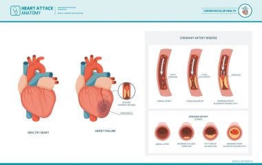 Heart attack and atherosclerosis medical illustration clipart