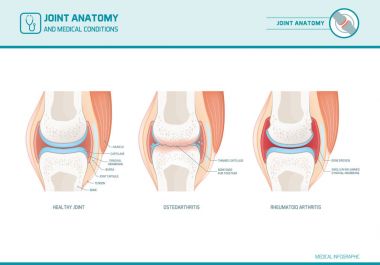 Ortak anatomi, Osteoartrit ve romatoid artrit 