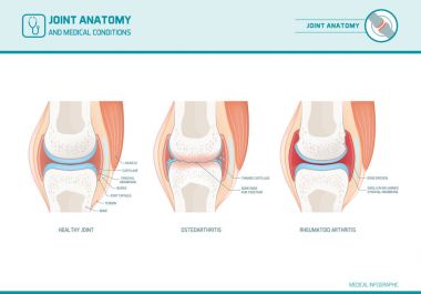 Joint anatomy, osteoarthritis and rheumatoid arthritis  clipart