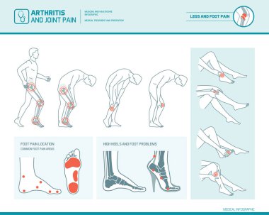 Ayak ağrısı, bacak ağrı ve artrit Infographic