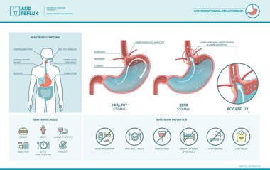Acid reflux and heartburn infographic clipart