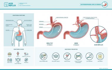 Acid reflux and heartburn infographic clipart