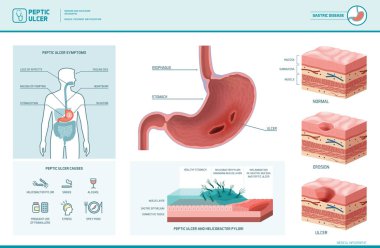 Peptik ülser ve helicobacter pylori Infographic