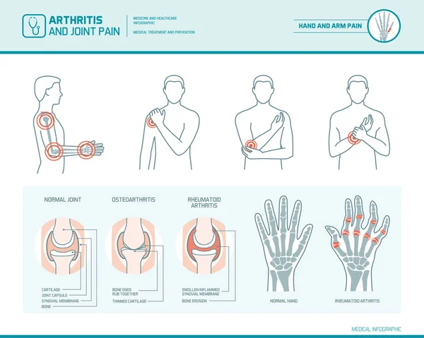 könyök artritisz kenőcskezelés troxevasin a térd artrózisához
