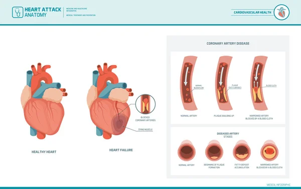 Ataque cardíaco y aterosclerosis ilustración médica — Vector de stock