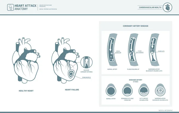 Ataque cardíaco y aterosclerosis ilustración médica — Archivo Imágenes Vectoriales