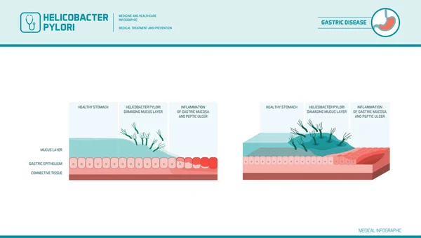 Helicobacter pylori infectando o estômago — Vetor de Stock