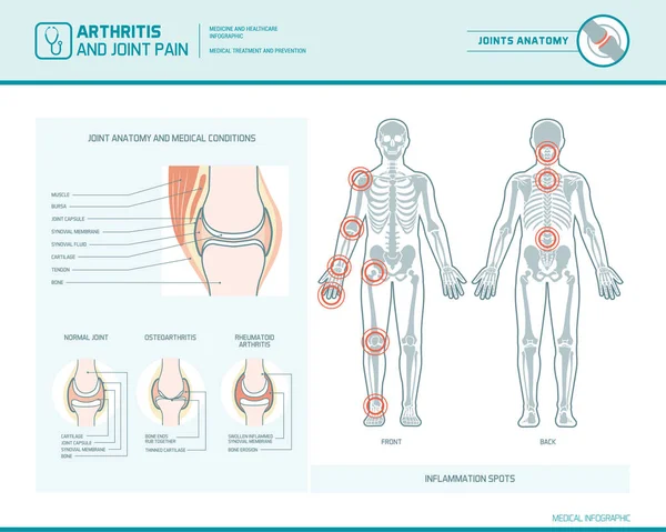 Artritis reumatoide, osteoartritis y dolor articular i — Archivo Imágenes Vectoriales