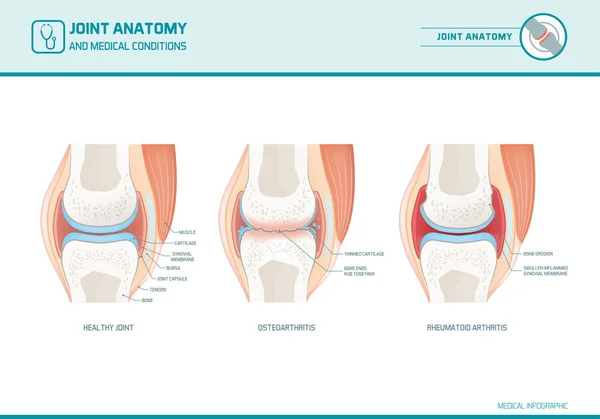 Ortak anatomi, Osteoartrit ve romatoid artrit 