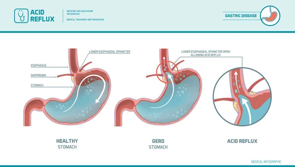 Acid reflux and heartburn infographic - Stok Vektor