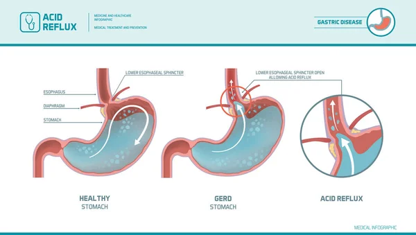 Säurerereflux und Sodbrennen Infografik — Stockvektor