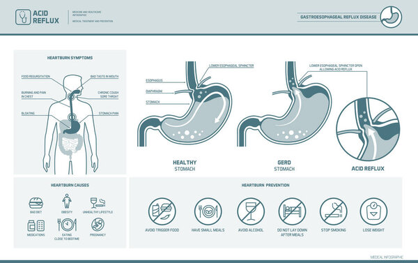 Acid reflux and heartburn infographic