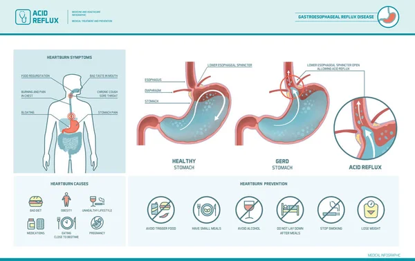 Asit reflü ve mide ekşimesi Infographic