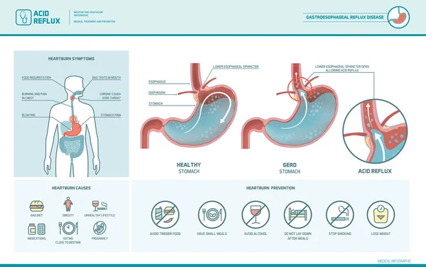Acid reflux and heartburn infographic - Stok Vektor
