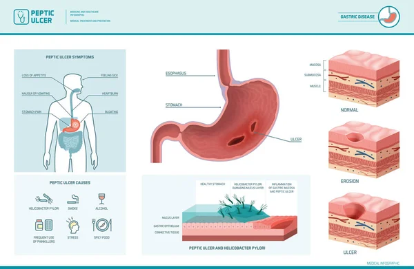 Peptic ulcer dan helicopter obacter pylori infographic - Stok Vektor
