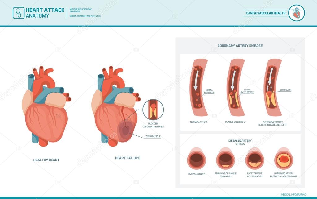 Heart attack and atherosclerosis medical illustration