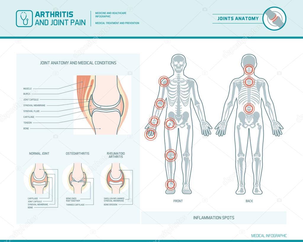 Rheumatoid arthritis, osteoarthritis and joint pain i