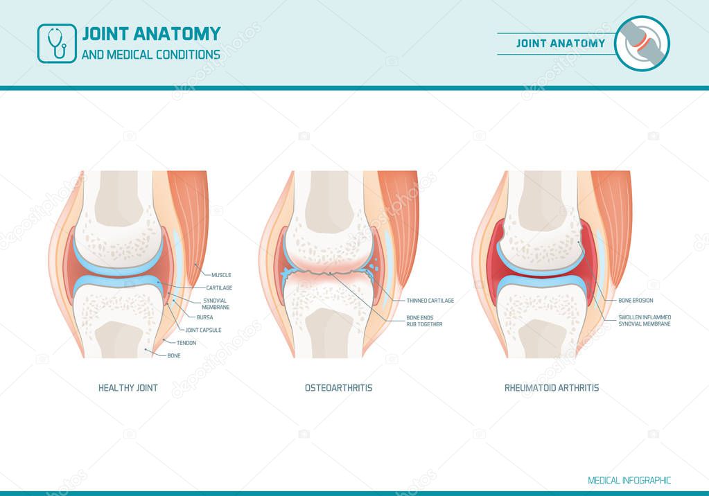Joint anatomy, osteoarthritis and rheumatoid arthritis 