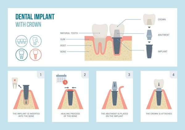 Dental implant medical procedure and structure — 스톡 벡터