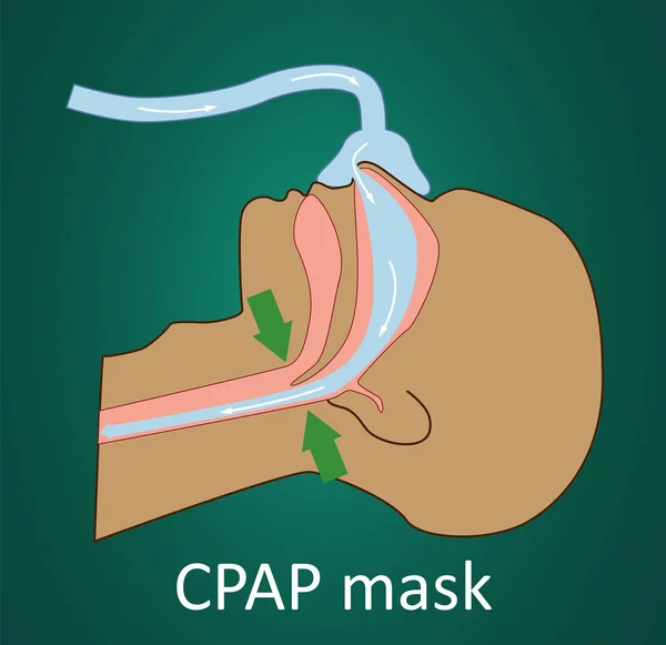 Ilustração vetorial da respiração com máscara CPAP . —  Vetores de Stock