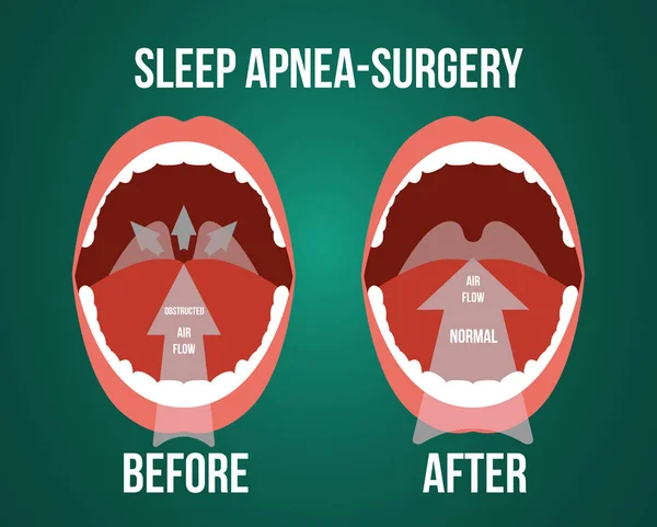 Illustration vectorielle de la chirurgie pour l'apnée obstructive du sommeil . — Image vectorielle