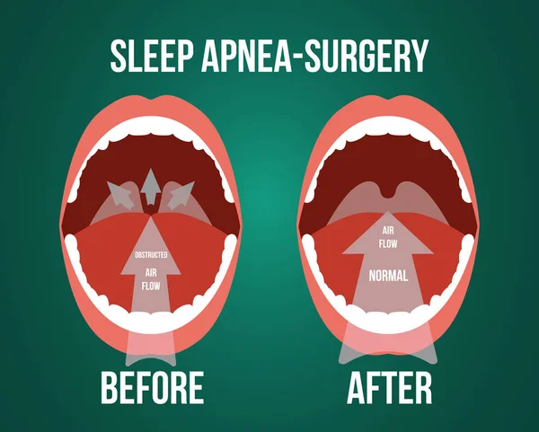 Ilustración vectorial de cirugía para la apnea obstructiva del sueño . — Archivo Imágenes Vectoriales