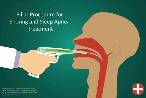 Vectorillustratie van de procedures voor slaap apneu pijler operatie. — Stockvector