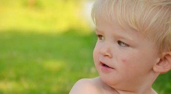 Niño pequeño con picadura de mosquito en la cara . — Foto de Stock