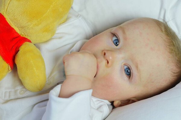 Baby boy suffering from sixth disease (three-day-fever or Roseola).