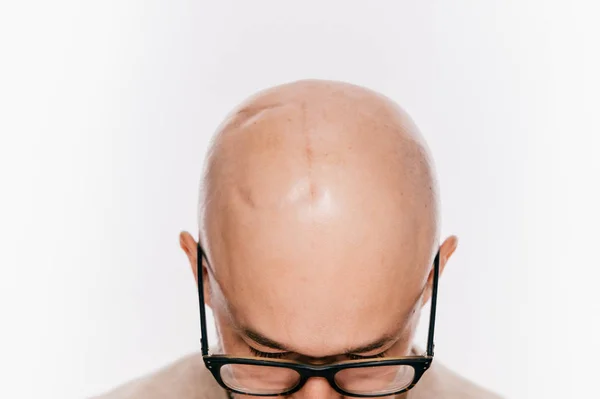 Fechamento da cabeça masculina careca após operação oncológica. Marcas de irradiação e quimioterapia do tumor cerebral. Paciente sobrevivente após o cancro. Homem sem pêlos com cicatrizes. Irritação da pele. Operação de neurocirurgia. — Fotografia de Stock