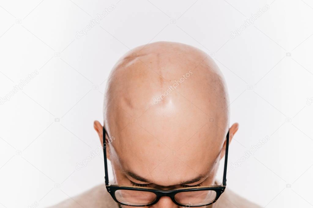 Closeup of bald male head after oncology operation. Brain tumor irradiation and chemotherapy marks. Survivor patient after cancer. Hairless man with scars. Skin irritation. Neurosurgery operation. 