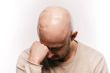 Bald man psychological stress struggling for life arter brain tumor. Heartbreaking male emotions after cancer neurosurgery operation. Oncology survivor patient. Chemotherapy and irradiation head marks clipart