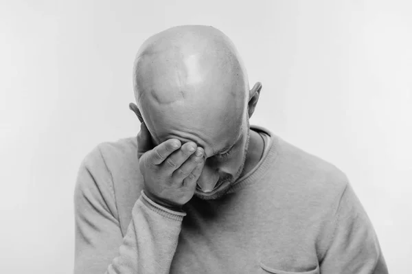 秃头男人为生命奋斗的心理压力会引起脑瘤.癌症神经外科手术后令人伤心的男性情绪。肿瘤幸存者病人。化疗和放疗头标记 — 图库照片