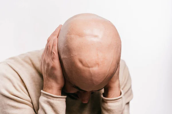 Bald man psychological stress struggling for life arter brain tumor. Heartbreaking male emotions after cancer neurosurgery operation. Oncology survivor patient. Chemotherapy and irradiation head marks