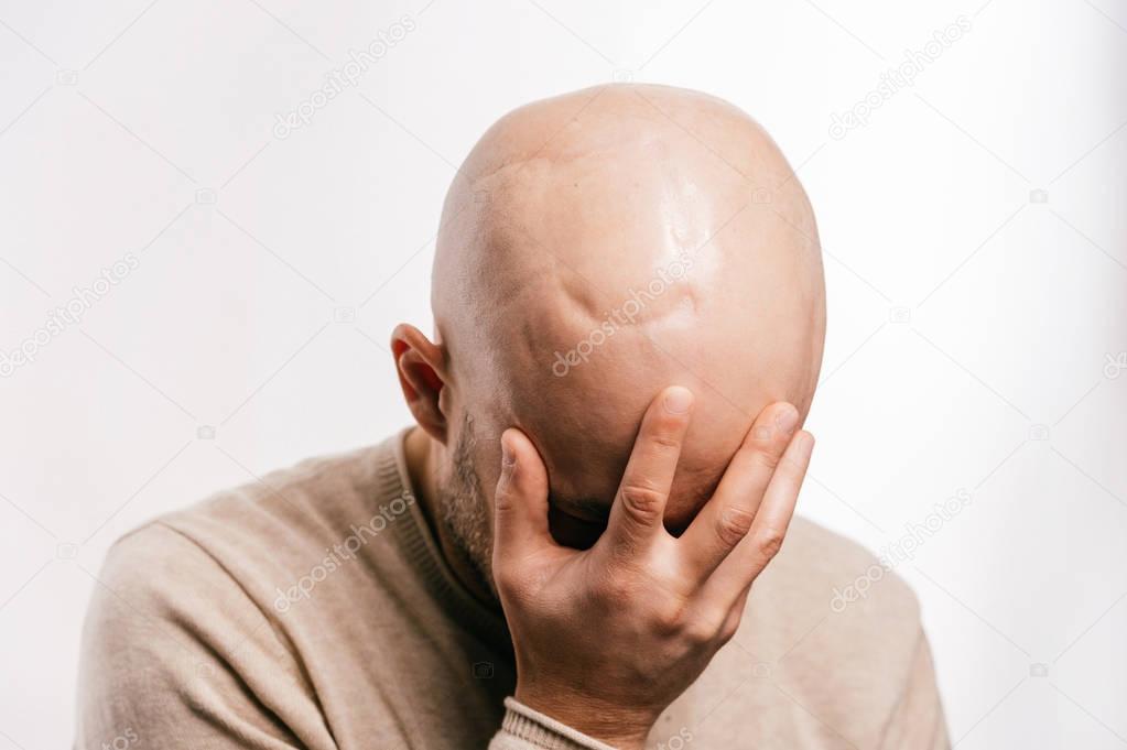 Bald man psychological stress struggling for life arter brain tumor. Heartbreaking male emotions after cancer neurosurgery operation. Oncology survivor patient. Chemotherapy and irradiation head marks