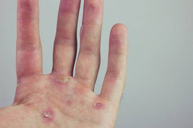 Blister ve Nasırlaşma ile el