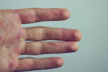 Blister ve Nasırlaşma ile el